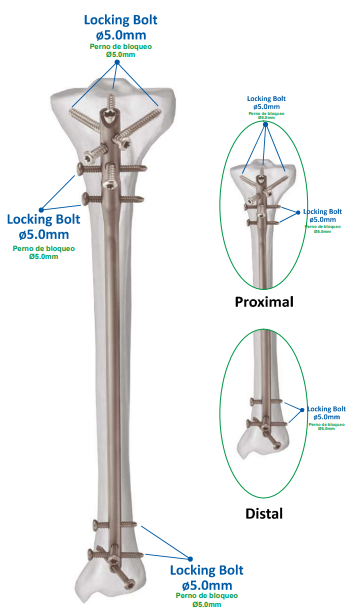 DAKSH Multi Tibia Nail-1